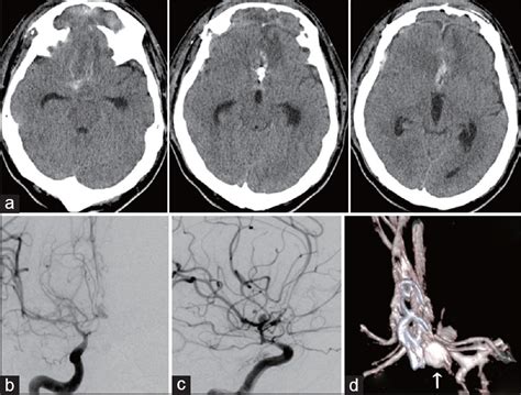 A difficult-to-treat Acom aneurysm with the combined vascular anomaly ...