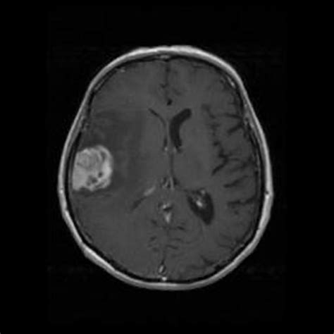 Pleomorphic xanthoastrocytoma | Radiology Reference Article ...