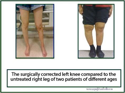 Types of Bowlegs and Operation Methods to Cure : Part 4 - Bangkok ...