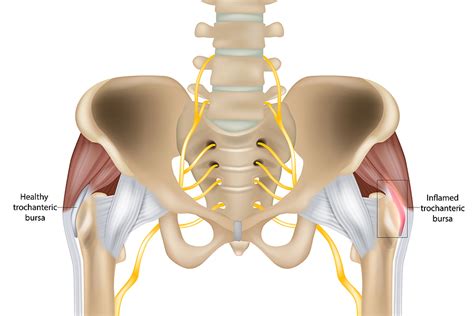 Bursitis of the Hip Arlington VA | Nirschl Orthopaedic Center