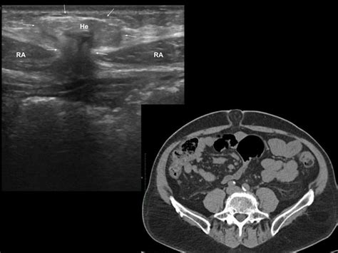 Epigastric Hernia Ultrasound