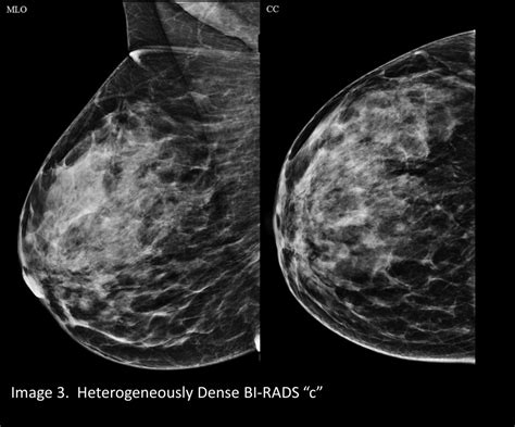 Your patient got a dense breast notification with her mammogram report ...