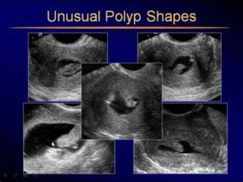 Sonohysterography Usual and Unusual Findings - YouTube