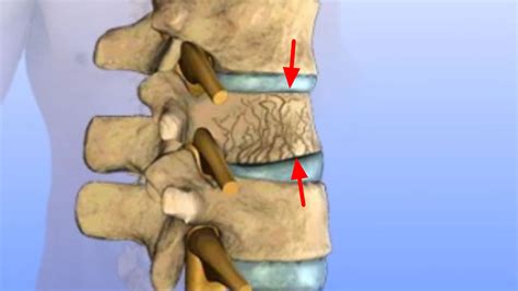 Compression fracture spine causes, symptoms, diagnosis & treatment