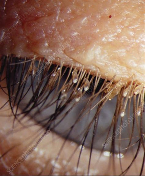 Lice in Eyes & Eyelashes | In-Home Head Lice Removal