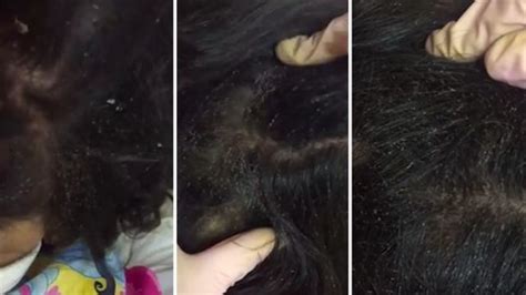 Mexican girl's hair is crawling with lice as it is inspected in video ...