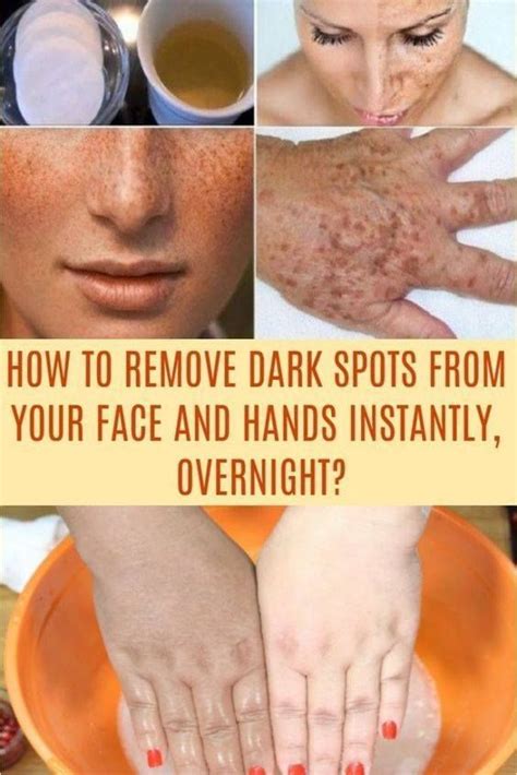 Natural Remedies To Remove Warts, Dark Spots, Blackheads And Skin Tags ...