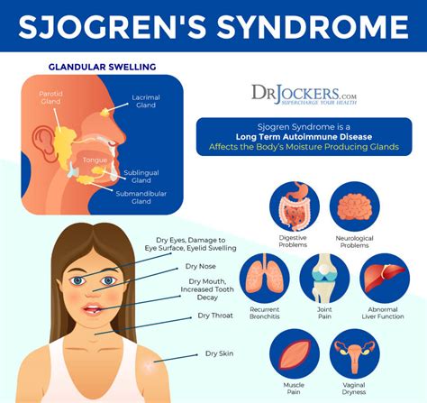 Sjogren’s Syndrome: Symptoms, Causes, and Support Strategies