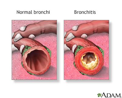 Copd And Coughing Up Mucus