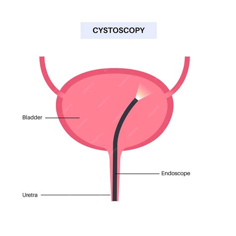 Premium Vector | Cystoscopy is a minimally invasive procedure ...