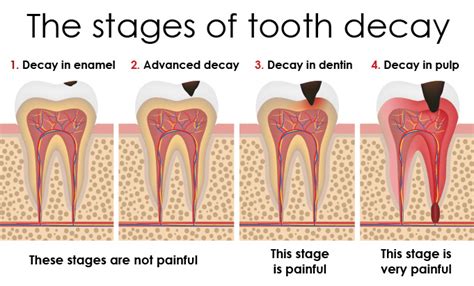 What Causes Tooth Decay and How to Treat It | Helpful Tips