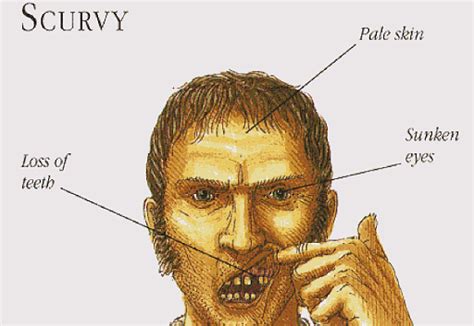 Scurvy: Vitamin C Deficiency, Symptoms & Treatment