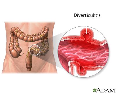 Diverticulitis Information | Mount Sinai - New York