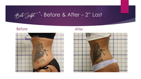 4-Before & After Sculpt-Stomach - Healthworks