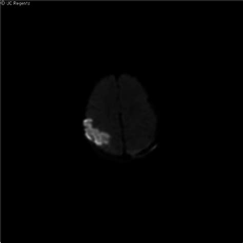 This diffusion-weighted image shows restricted diffusion in the ...