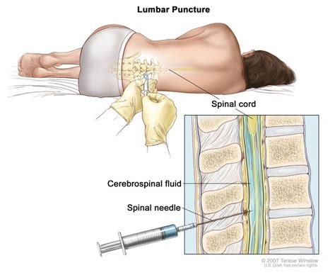 Childhood Medulloblastoma & Other CNS Embryonal Tumors Treatment - NCI