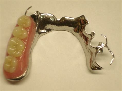 Dental Bridges, a Complete Overview