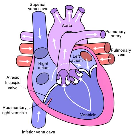 Tricuspid Atresia - Costamedic