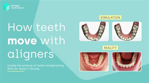 How aligners move teeth: The science behind it