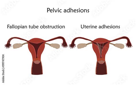 Pelvic adhersions. Uterine adhesions and fallopian tube obstruction ...