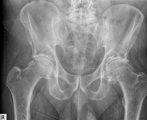 Osteoarthritis of the Hip