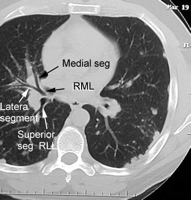 Bronchial tree