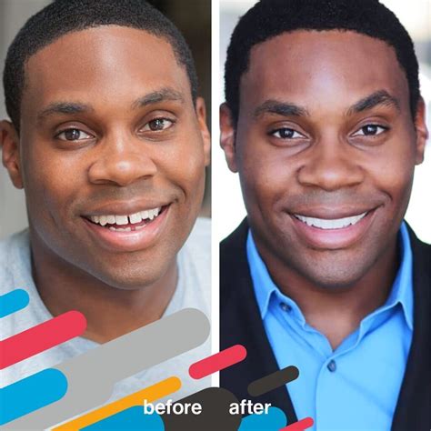 Invisalign Before and After PicturesDr. Jacquie