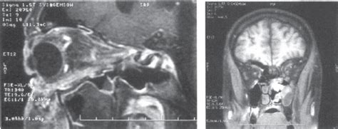 MRI with contrast dye showing filled out left-side para- | Download ...