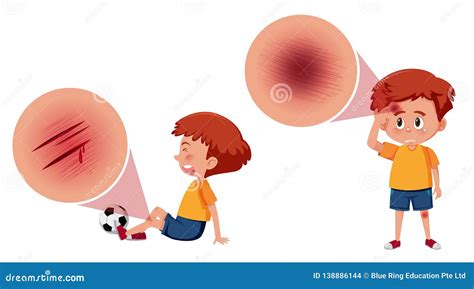 Boy with open wound stock vector. Illustration of medical - 138886144