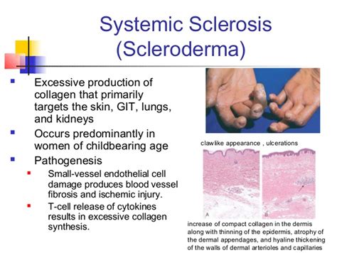 Scleroderma - Myositis Support and Understanding