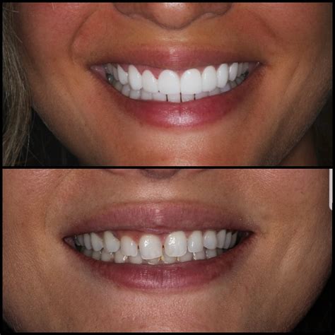 Why Do Porcelain Veneers Cost So Little In Colombia? — Dental Tourism ...