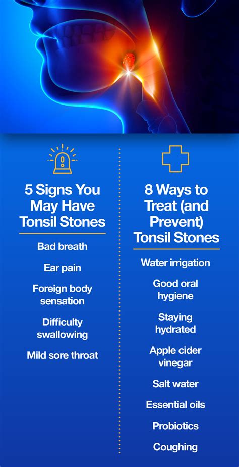 What Causes Tonsil Stones? And What Do We Do About It? – The Amino Company