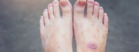 Gangrene : Causes, Symptoms And Treatment | Netmeds