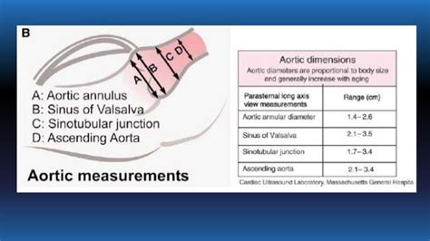 Echo assessment of aortic valve disease