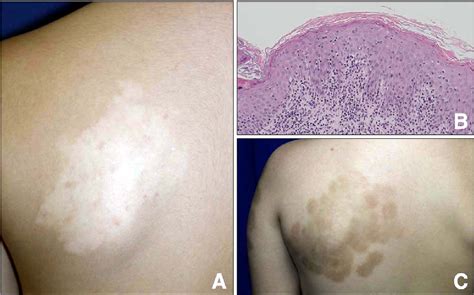 [PDF] Hypopigmented Mycosis Fungoides Treated with 308 nm Excimer Laser ...