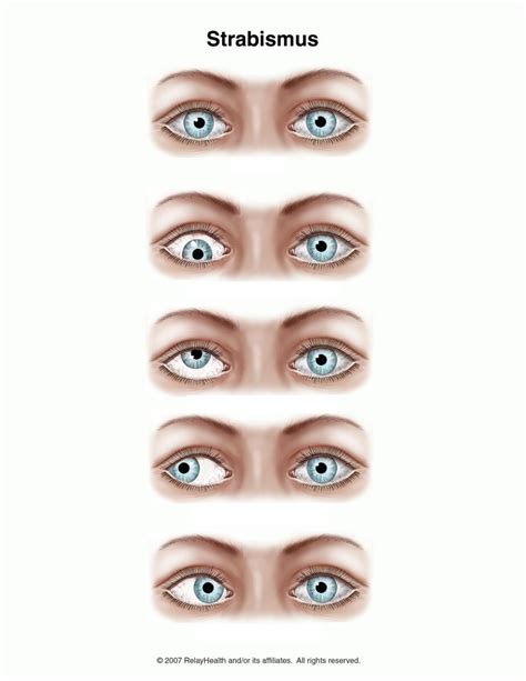 Table 11-7: Dysconjugate Gaze Diagram | Quizlet