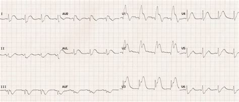 life in the fast lane ecg stemi - Unlimited Blogged Custom Image Library