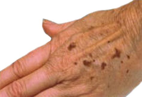 Age Spots Home Remedy | Beauty remedies, Home remedies, Health