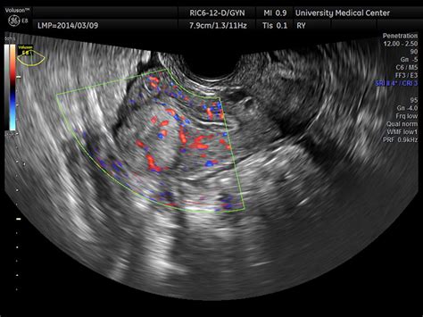 Vaginal Ultrasound Showing Atrophy Of The Uterus And Ovaries | Hot Sex ...