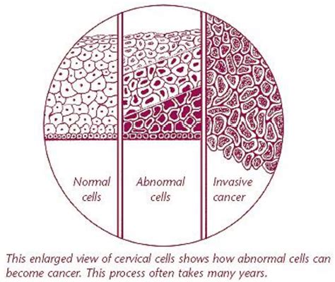 Atypical Squamous Cells Cervix