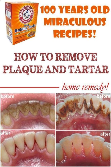 How to Remove Teeth Plaque At Home, Tips to Control Tartar - Health care