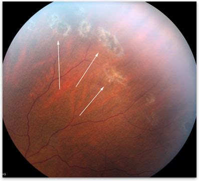 Lattice Degeneration - Retina-Vitreous Surgeons of CNY