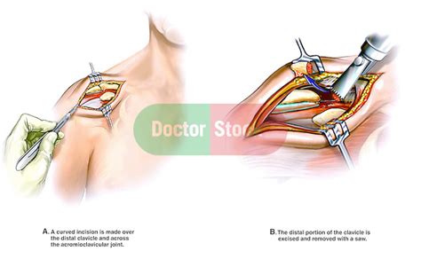 Shoulder Surgery - Open Mumford Procedure | Doctor Stock