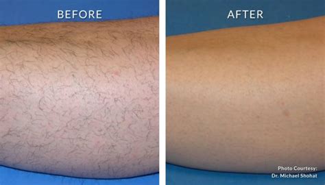 Laser hair removal before and after