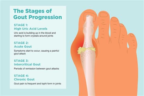 The 4 Stages of Gout and Preventing Disease Progression