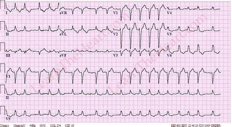 Left Bundle Branch Block ECG (Example 7) | LearntheHeart.com