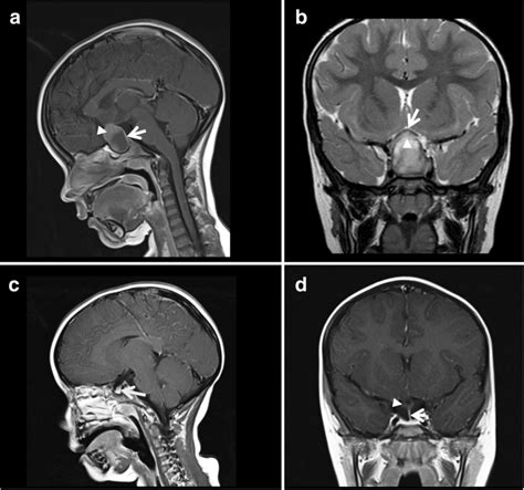 Sagittal pre-operative post-contrast T1 MRI brain scan image at ...