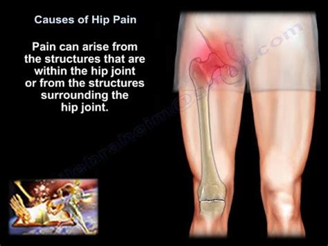 Hip pain: causes, symptoms and treatment - medical - 2024