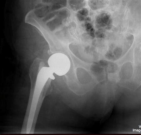 Hip Fracture – Femoral Neck Fracture – Undergraduate Diagnostic Imaging ...