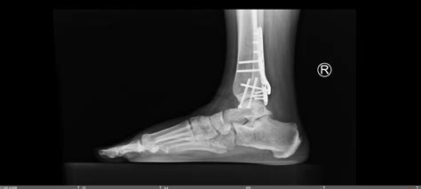 Trimalleolar Ankle Fracture — Chicago Foot & Ankle Orthopaedic Surgeons